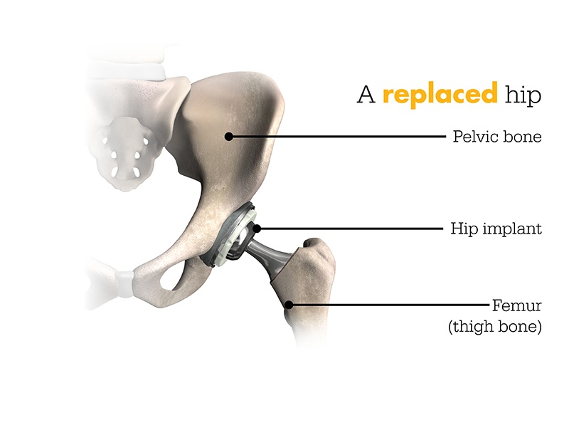 Replacement Hip