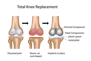 Knee Replacement: Am I a good candidate for a Knee Replacement?