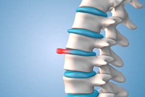Understanding Herniated Discs: Causes, Symptoms, and Treatments