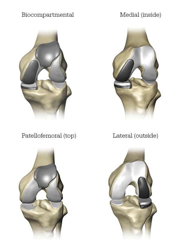 bicompartmental knee replacement