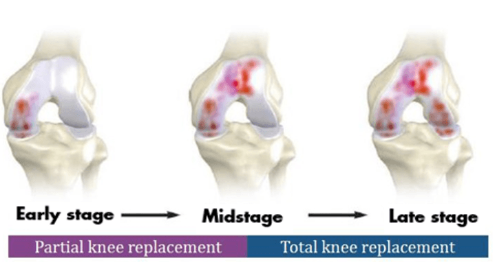 Total Knee Vs. Partial Knee Replacement
